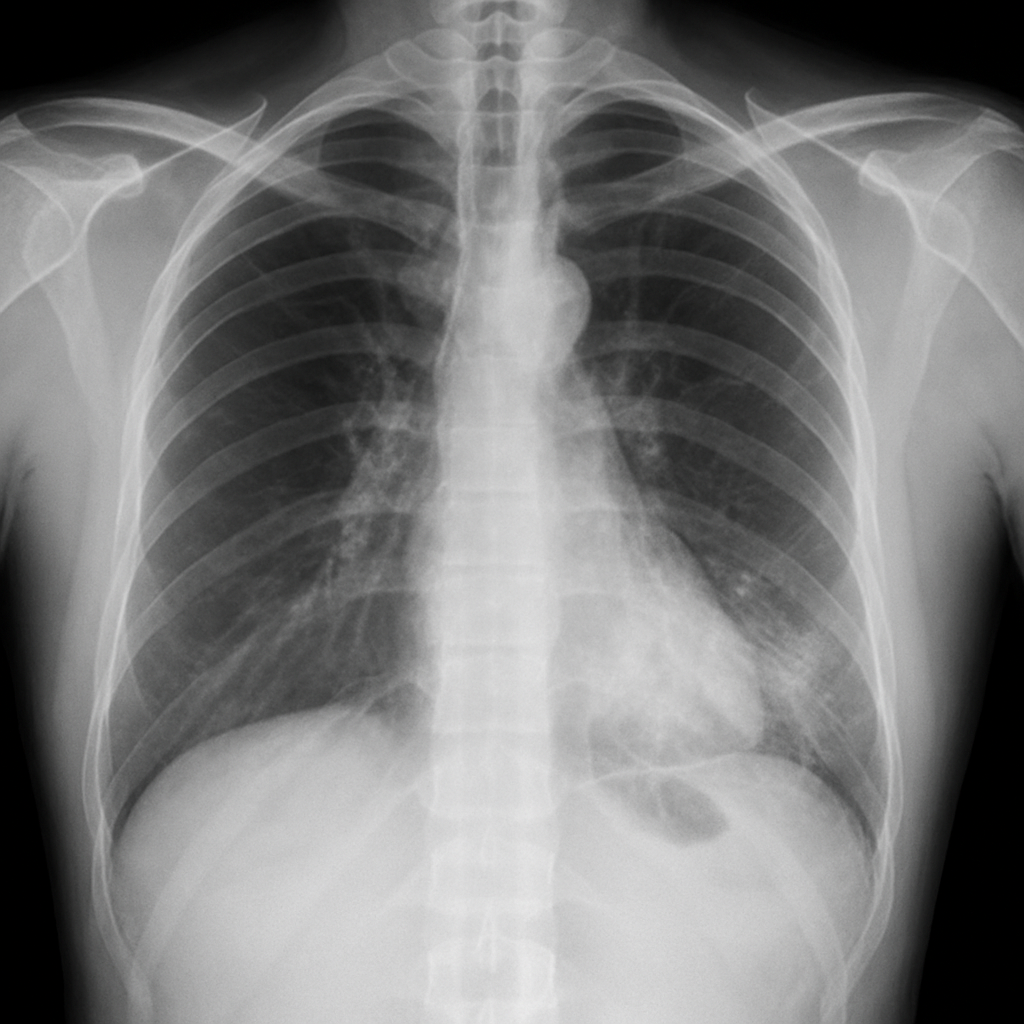 Imagem de exemplo exemplo_pneumonia.png